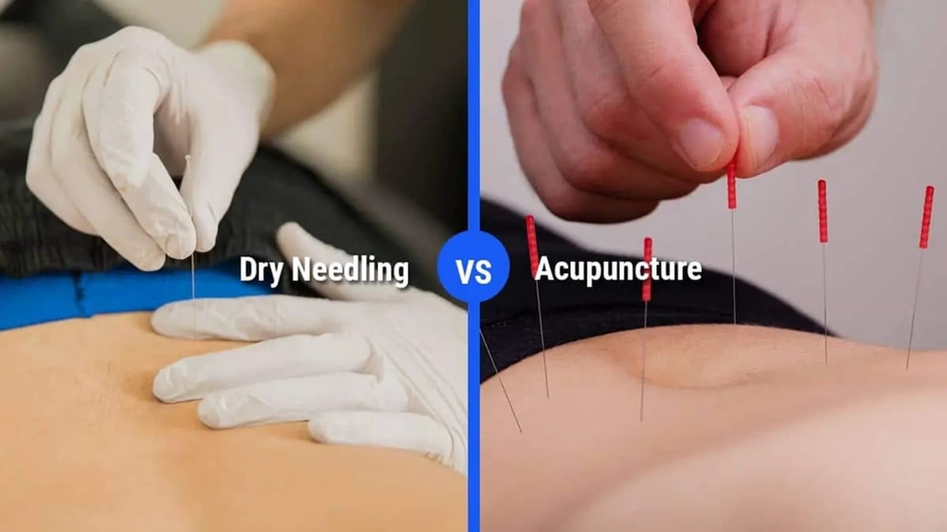 Dry Needling vs. Acupuncture in Physiotherapy: Key Differences