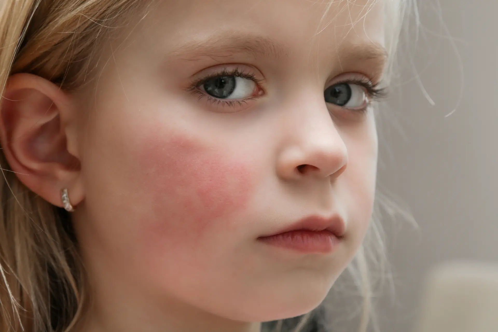 Hypersensitivity