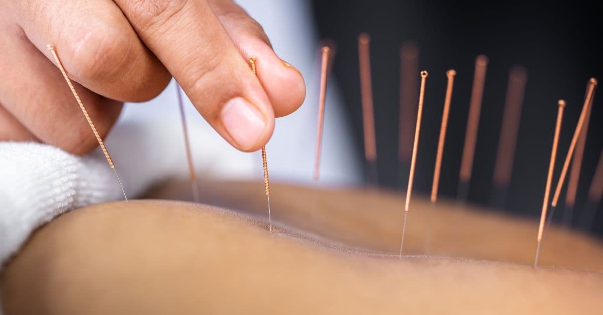 Acupuncture: Origins, Methods, Benefits, and Modern Understanding