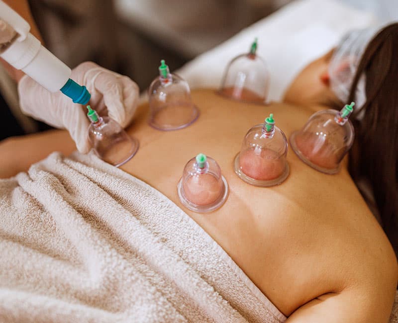 Wet cupping therapy - Hijama
